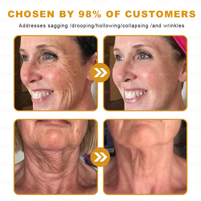🌿𝐏𝐔𝐑𝐎𝐒𝐀® 8-𝑰𝒏-1 𝑩𝒆𝒆 𝑽𝒆𝒏𝒐𝒎 & 𝑻𝒂𝒍𝒍𝒐𝒘 𝑺𝒌𝒊𝒏 𝑭𝒊𝒓𝒎𝒊𝒏𝒈 & 𝑻𝒓𝒆𝒂𝒕𝒎𝒆𝒏𝒕 𝑪𝒓𝒆𝒂𝒎 Anti-aging, Hydrating, Skin Repair, Even Tone, Acne and Dark Spot Treatment, Wart and Mole Removal, Psoriasis Relief