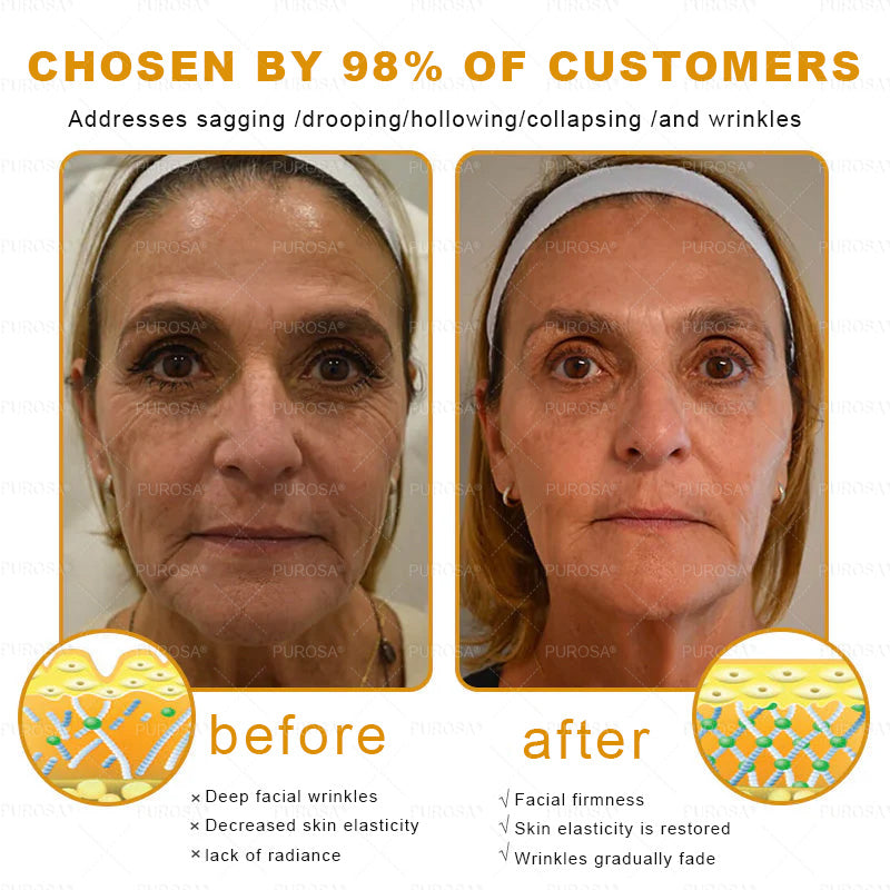 🌿𝐏𝐔𝐑𝐎𝐒𝐀® 8-𝑰𝒏-1 𝑩𝒆𝒆 𝑽𝒆𝒏𝒐𝒎 & 𝑻𝒂𝒍𝒍𝒐𝒘 𝑺𝒌𝒊𝒏 𝑭𝒊𝒓𝒎𝒊𝒏𝒈 & 𝑻𝒓𝒆𝒂𝒕𝒎𝒆𝒏𝒕 𝑪𝒓𝒆𝒂𝒎 Anti-aging, Hydrating, Skin Repair, Even Tone, Acne and Dark Spot Treatment, Wart and Mole Removal, Psoriasis Relief