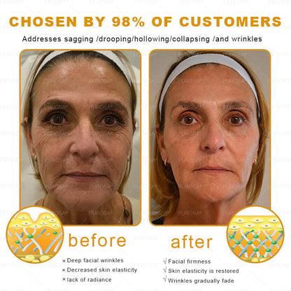 🌿𝐏𝐔𝐑𝐎𝐒𝐀® 8-𝑰𝒏-1 𝑩𝒆𝒆 𝑽𝒆𝒏𝒐𝒎 & 𝑻𝒂𝒍𝒍𝒐𝒘 𝑺𝒌𝒊𝒏 𝑭𝒊𝒓𝒎𝒊𝒏𝒈 & 𝑻𝒓𝒆𝒂𝒕𝒎𝒆𝒏𝒕 𝑪𝒓𝒆𝒂𝒎 Anti-aging, Hydrating, Skin Repair, Even Tone, Acne and Dark Spot Treatment, Wart and Mole Removal, Psoriasis Relief