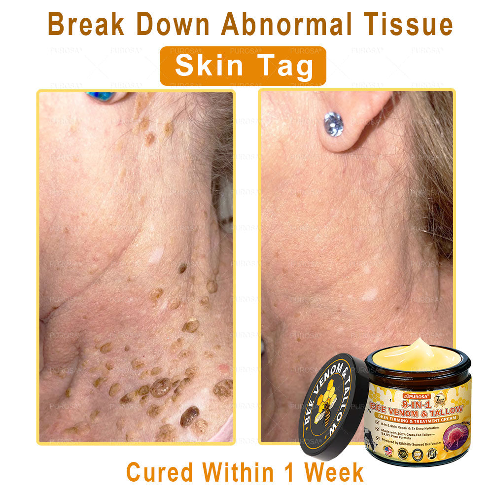 🌿𝐏𝐔𝐑𝐎𝐒𝐀® 8-𝑰𝒏-1 𝑩𝒆𝒆 𝑽𝒆𝒏𝒐𝒎 & 𝑻𝒂𝒍𝒍𝒐𝒘 𝑺𝒌𝒊𝒏 𝑭𝒊𝒓𝒎𝒊𝒏𝒈 & 𝑻𝒓𝒆𝒂𝒕𝒎𝒆𝒏𝒕 𝑪𝒓𝒆𝒂𝒎 Anti-aging, Hydrating, Skin Repair, Even Tone, Acne and Dark Spot Treatment, Wart and Mole Removal, Psoriasis Relief