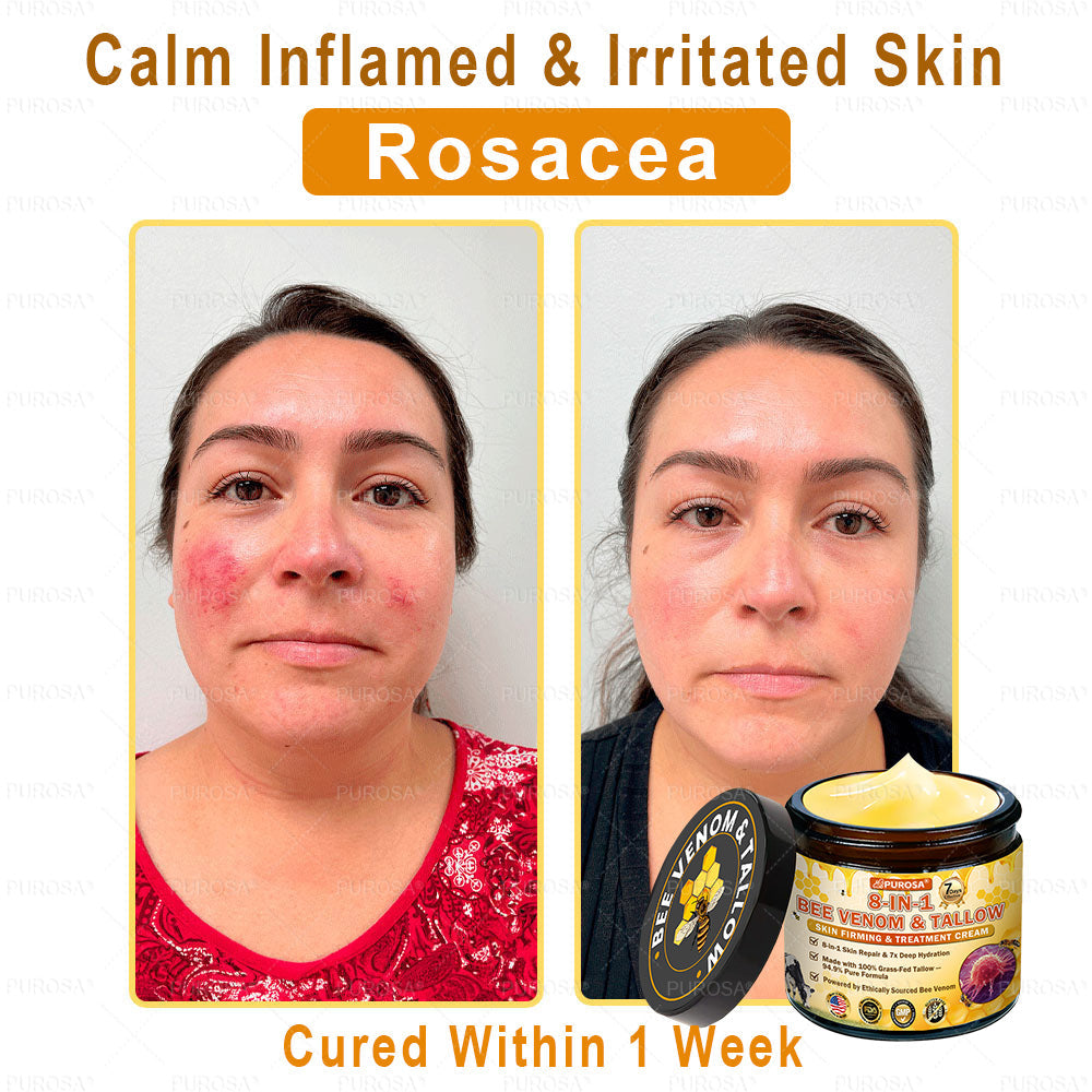🌿𝐏𝐔𝐑𝐎𝐒𝐀® 8-𝑰𝒏-1 𝑩𝒆𝒆 𝑽𝒆𝒏𝒐𝒎 & 𝑻𝒂𝒍𝒍𝒐𝒘 𝑺𝒌𝒊𝒏 𝑭𝒊𝒓𝒎𝒊𝒏𝒈 & 𝑻𝒓𝒆𝒂𝒕𝒎𝒆𝒏𝒕 𝑪𝒓𝒆𝒂𝒎 Anti-aging, Hydrating, Skin Repair, Even Tone, Acne and Dark Spot Treatment, Wart and Mole Removal, Psoriasis Relief