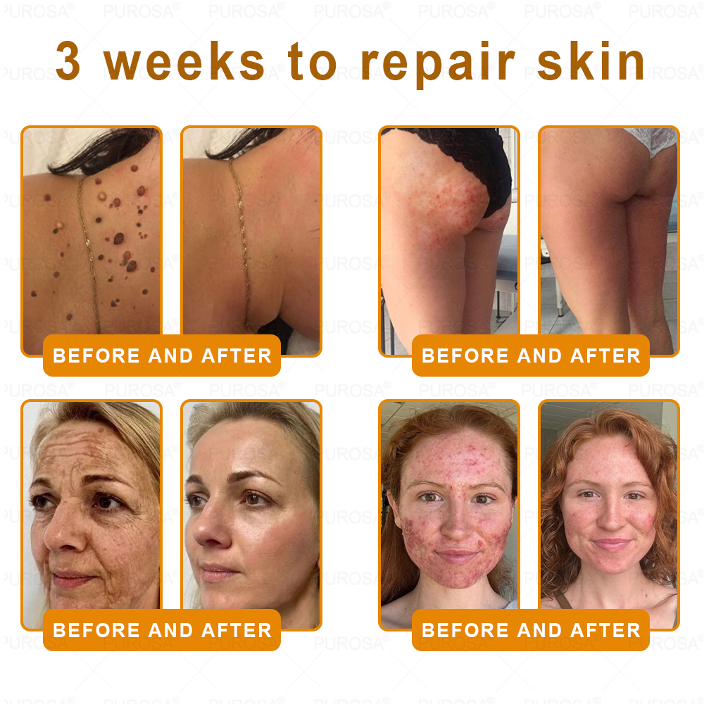 🐝🐝🐝𝗣𝗨𝗥𝗢𝗦𝗔® 𝟖-𝐈𝐧-𝟏 𝐁𝐞𝐞 𝐕𝐞𝐧𝐨𝐦 & 𝐓𝐚𝐥𝐥𝐨𝐰 𝐒𝐤𝐢𝐧 𝐅𝐢𝐫𝐦𝐢𝐧𝐠 & 𝐓𝐫𝐞𝐚𝐭𝐦𝐞𝐧𝐭 𝐂𝐫𝐞𝐚𝐦 (Effective Within 7 Days)Bee Venom + Tallow · 7X Deep Hydration, targets wrinkles, sagging, stretch marks, dark spots, purpura, inflammations and more