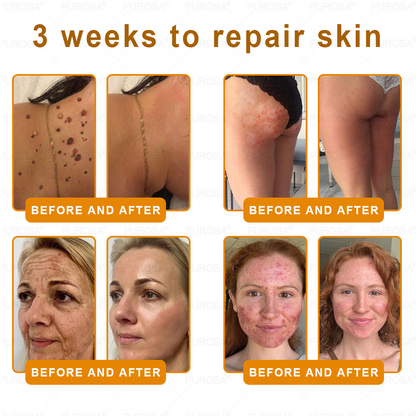 🐝🐝🐝𝗣𝗨𝗥𝗢𝗦𝗔® 𝟖-𝐈𝐧-𝟏 𝐁𝐞𝐞 𝐕𝐞𝐧𝐨𝐦 & 𝐓𝐚𝐥𝐥𝐨𝐰 𝐒𝐤𝐢𝐧 𝐅𝐢𝐫𝐦𝐢𝐧𝐠 & 𝐓𝐫𝐞𝐚𝐭𝐦𝐞𝐧𝐭 𝐂𝐫𝐞𝐚𝐦 (Effective Within 7 Days)Bee Venom + Tallow · 7X Deep Hydration, targets wrinkles, sagging, stretch marks, dark spots, purpura, inflammations and more
