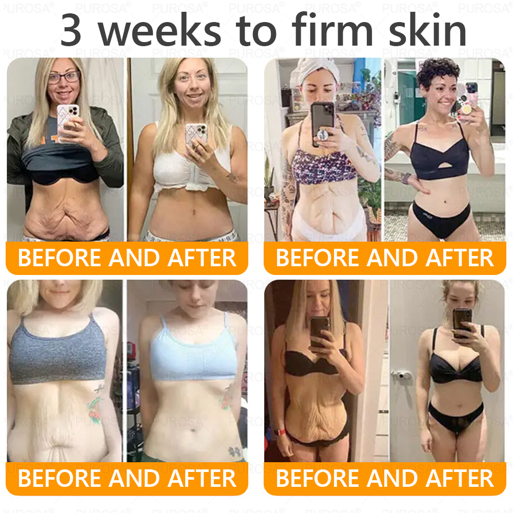 🐝🐝🐝𝗣𝗨𝗥𝗢𝗦𝗔® 𝟖-𝐈𝐧-𝟏 𝐁𝐞𝐞 𝐕𝐞𝐧𝐨𝐦 & 𝐓𝐚𝐥𝐥𝐨𝐰 𝐒𝐤𝐢𝐧 𝐅𝐢𝐫𝐦𝐢𝐧𝐠 & 𝐓𝐫𝐞𝐚𝐭𝐦𝐞𝐧𝐭 𝐂𝐫𝐞𝐚𝐦 (Effective Within 7 Days)Bee Venom + Tallow · 7X Deep Hydration, targets wrinkles, sagging, stretch marks, dark spots, purpura, inflammations and more
