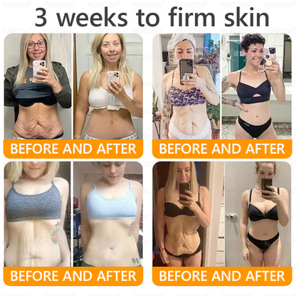 🐝🐝🐝𝗣𝗨𝗥𝗢𝗦𝗔® 𝟖-𝐈𝐧-𝟏 𝐁𝐞𝐞 𝐕𝐞𝐧𝐨𝐦 & 𝐓𝐚𝐥𝐥𝐨𝐰 𝐒𝐤𝐢𝐧 𝐅𝐢𝐫𝐦𝐢𝐧𝐠 & 𝐓𝐫𝐞𝐚𝐭𝐦𝐞𝐧𝐭 𝐂𝐫𝐞𝐚𝐦 (Effective Within 7 Days)Bee Venom + Tallow · 7X Deep Hydration, targets wrinkles, sagging, stretch marks, dark spots, purpura, inflammations and more