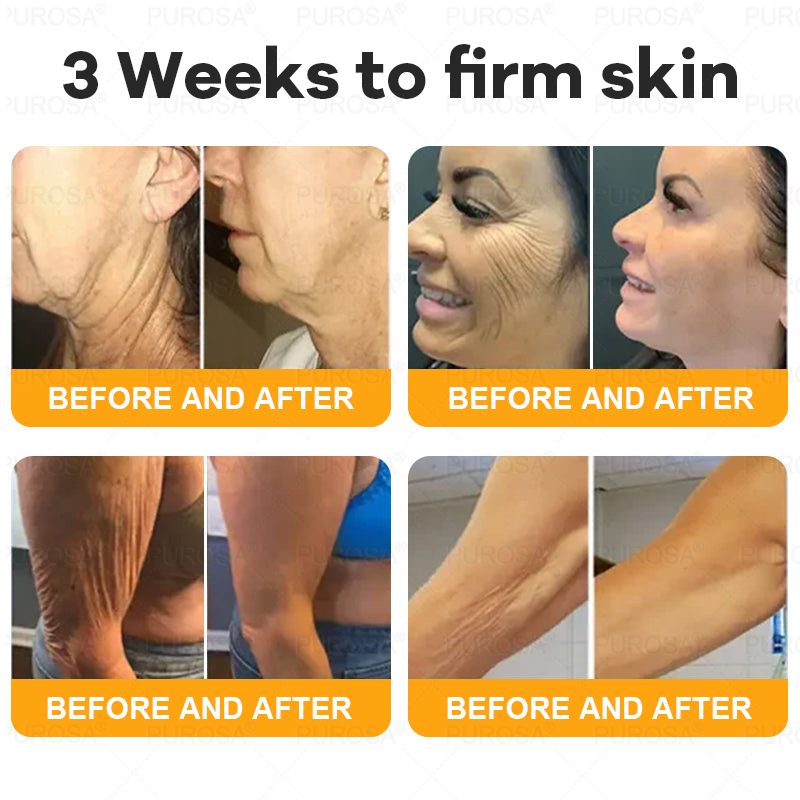 🐝🐝🐝𝗣𝗨𝗥𝗢𝗦𝗔® 𝟖-𝐈𝐧-𝟏 𝐁𝐞𝐞 𝐕𝐞𝐧𝐨𝐦 & 𝐓𝐚𝐥𝐥𝐨𝐰 𝐒𝐤𝐢𝐧 𝐅𝐢𝐫𝐦𝐢𝐧𝐠 & 𝐓𝐫𝐞𝐚𝐭𝐦𝐞𝐧𝐭 𝐂𝐫𝐞𝐚𝐦 (Effective Within 7 Days)Bee Venom + Tallow · 7X Deep Hydration, targets wrinkles, sagging, stretch marks, dark spots, purpura, inflammations and more