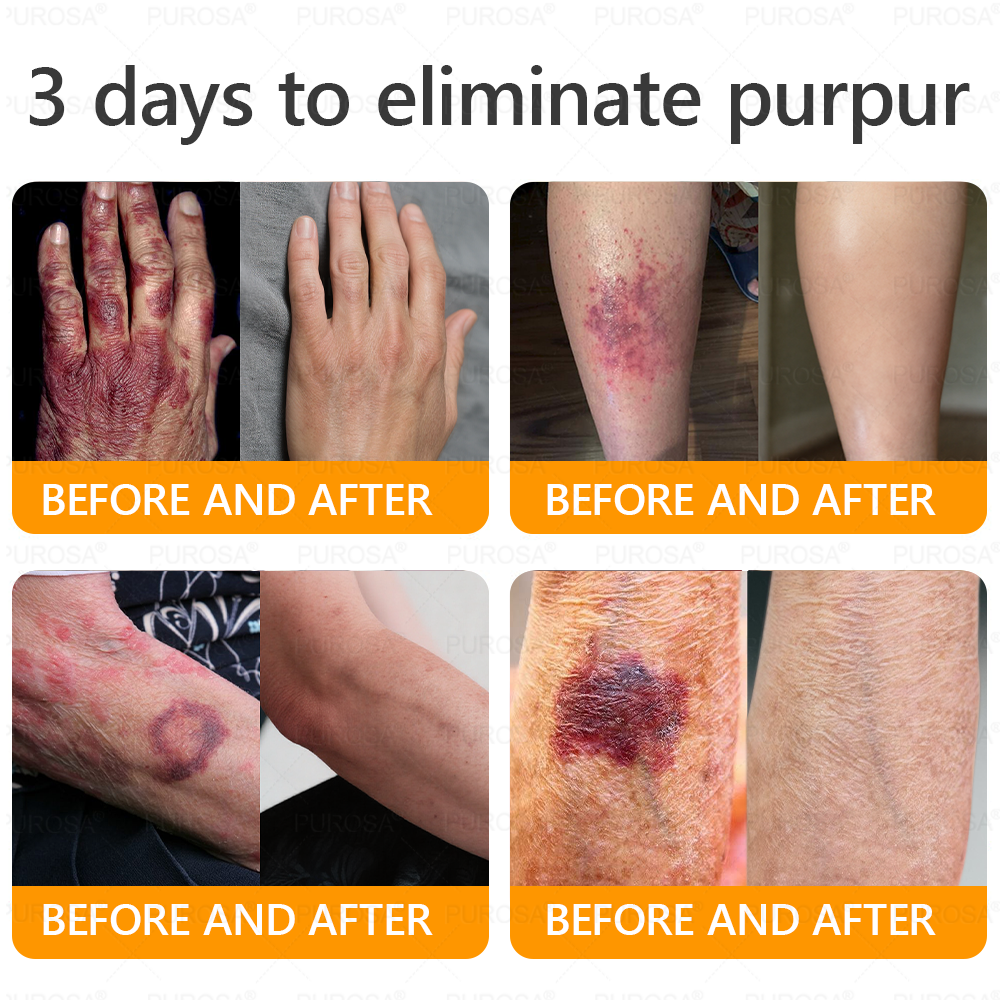 🐝🐝🐝𝗣𝗨𝗥𝗢𝗦𝗔® 𝟖-𝐈𝐧-𝟏 𝐁𝐞𝐞 𝐕𝐞𝐧𝐨𝐦 & 𝐓𝐚𝐥𝐥𝐨𝐰 𝐒𝐤𝐢𝐧 𝐅𝐢𝐫𝐦𝐢𝐧𝐠 & 𝐓𝐫𝐞𝐚𝐭𝐦𝐞𝐧𝐭 𝐂𝐫𝐞𝐚𝐦 (Effective Within 7 Days)Bee Venom + Tallow · 7X Deep Hydration, targets wrinkles, sagging, stretch marks, dark spots, purpura, inflammations and more