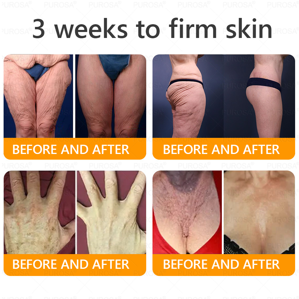 🐝🐝🐝𝗣𝗨𝗥𝗢𝗦𝗔® 𝟖-𝐈𝐧-𝟏 𝐁𝐞𝐞 𝐕𝐞𝐧𝐨𝐦 & 𝐓𝐚𝐥𝐥𝐨𝐰 𝐒𝐤𝐢𝐧 𝐅𝐢𝐫𝐦𝐢𝐧𝐠 & 𝐓𝐫𝐞𝐚𝐭𝐦𝐞𝐧𝐭 𝐂𝐫𝐞𝐚𝐦 (Effective Within 7 Days)Bee Venom + Tallow · 7X Deep Hydration, targets wrinkles, sagging, stretch marks, dark spots, purpura, inflammations and more